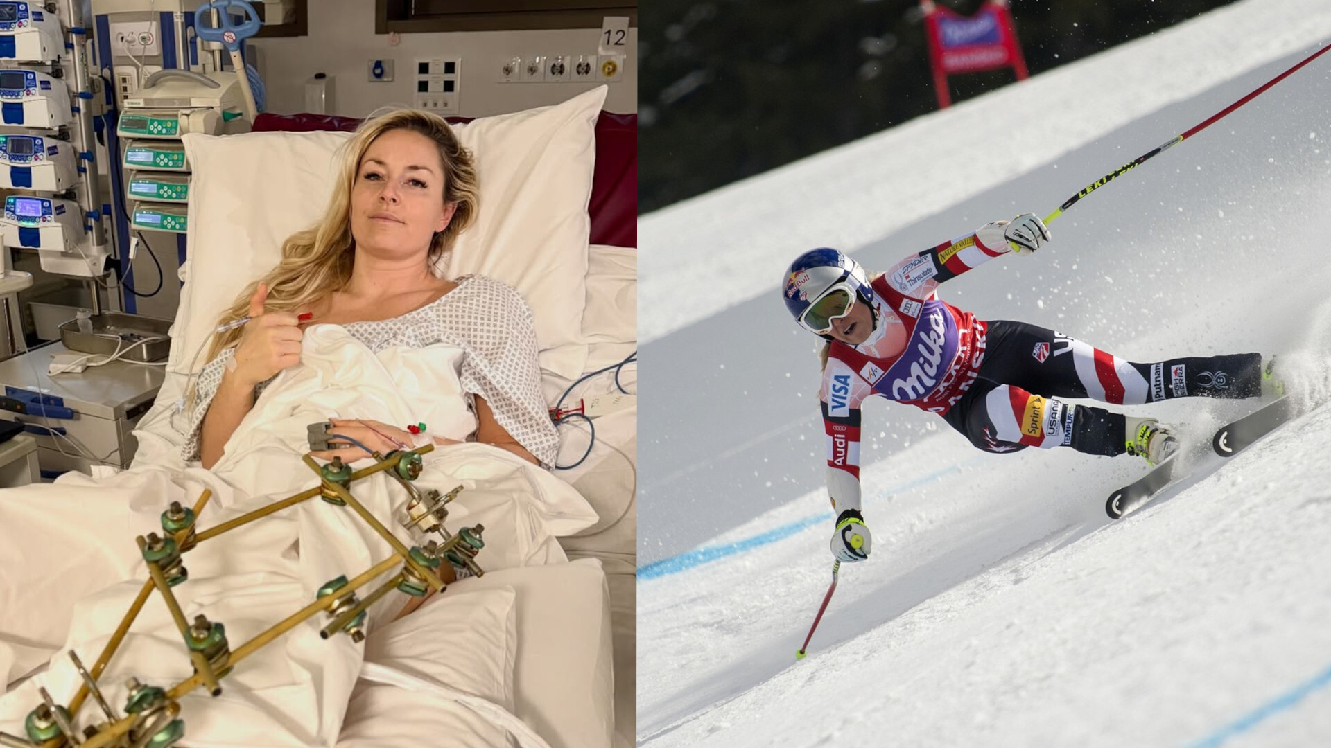Amerikalı kayakçı Lindsey Vonn bacağında üçüncü ameliyatı geçirdi